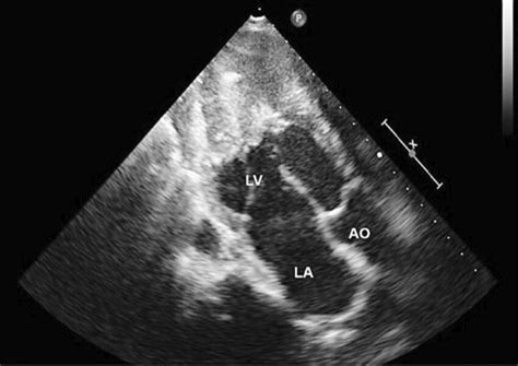 increased wall thickness on echocardiogram.